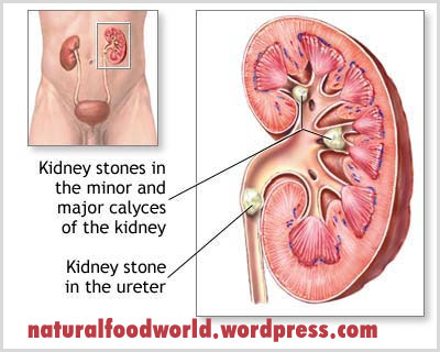 சிறுநீரக கல் பிரச்சினைக்கு ஆபரேஷன்(அறுவை சிகிச்சை) இல்லாமல் இயற்கை முறையில் குணப்படுத்தலாம். Kidneystone