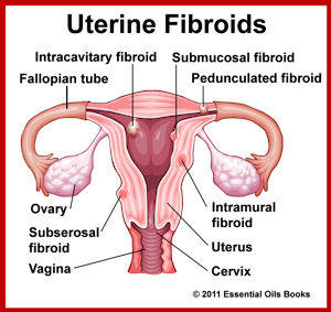 UterineFibroids
